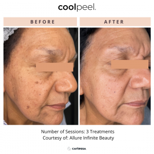 Sibél Aesthetics Introduces CoolPeel™ CO₂ Laser Resurfacing for Advanced Skin Rejuvenation With Minimal Downtime 7 coolpeel sibel aesthetics ba