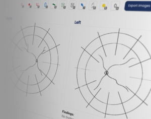 Partial screenshot of Moyae's retina drawing module showing a blank left and right eye diagram