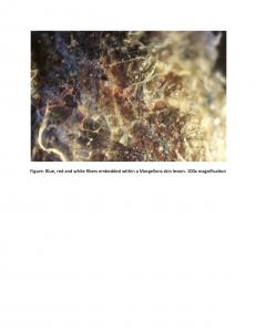 Morgellons skin lesion with fibers