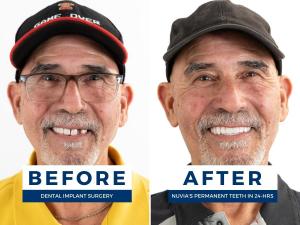 Man Smiling Before and After Getting Dental Implants