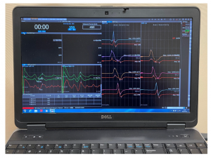Medtronic NIM Eclipse intraoperative neuromonitoring system displaying multichannel neurophysiological waveforms during neurosurgical monitoring at Dr. Rao’s Hospital.