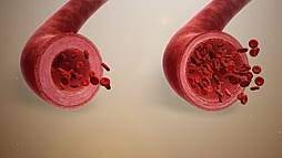 Blocked blood vessels can complicate medical conditions that may result in fatality Blood Vessels