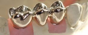 Stainless Crowns Market